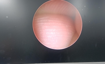 宮腔鏡常見故障及排查方法及YOUSHI宮腔一體鏡Y2052的維修案例