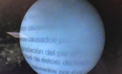 輸尿管鏡手術操作技巧的體會及R.Wolf輸尿管鏡的維修案例